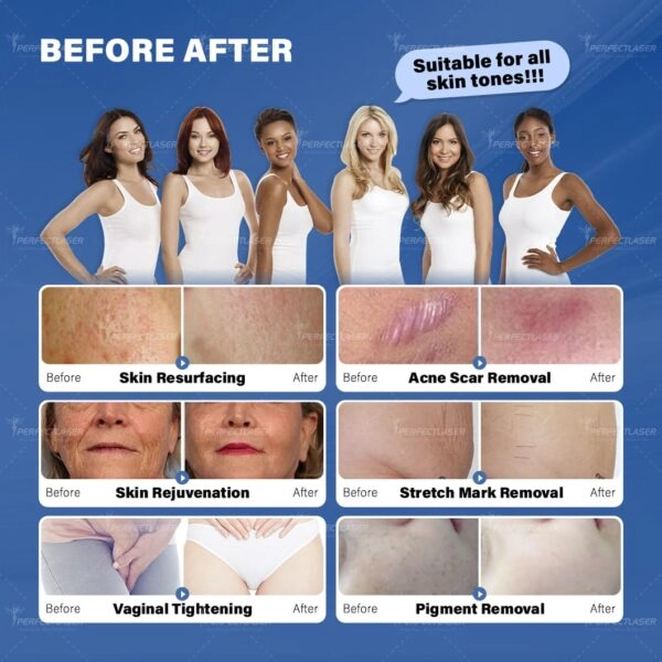 Reveal Smooth, Flawless Skin with CO2 Fractional Laser