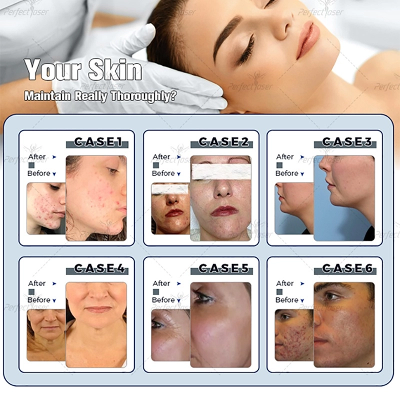 hydra Dermabrasion(2)