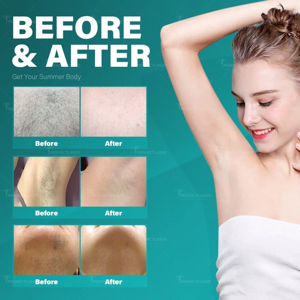 755nm 1064nm Alexandrite Laser Hair Removal Machine（2）