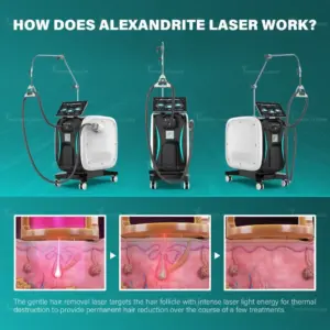 Alexandrite Laser Hair Removal Machine