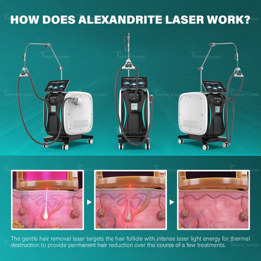Alexandrite Laser Hair Removal Machine