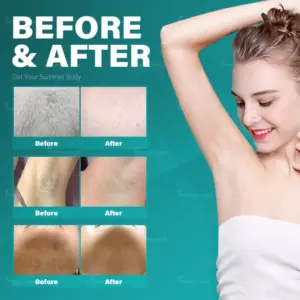 Alexandrite Laser Hair Removal Machine