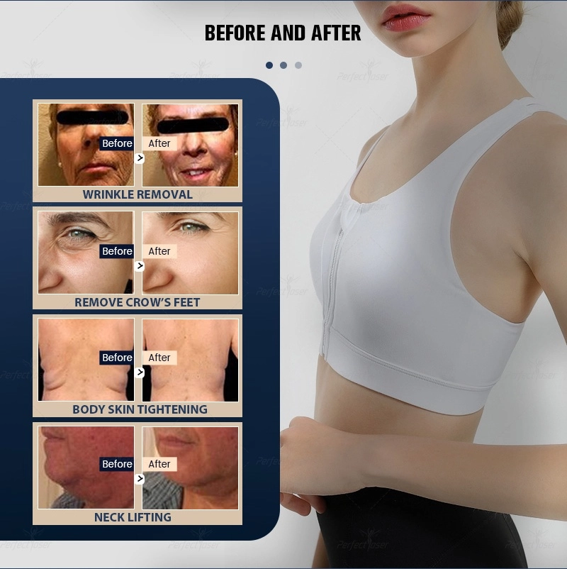 HIFU Beauty Machines