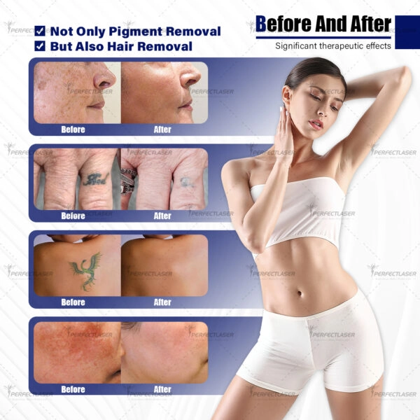Picosecond Tattoo Removal Machine(2)