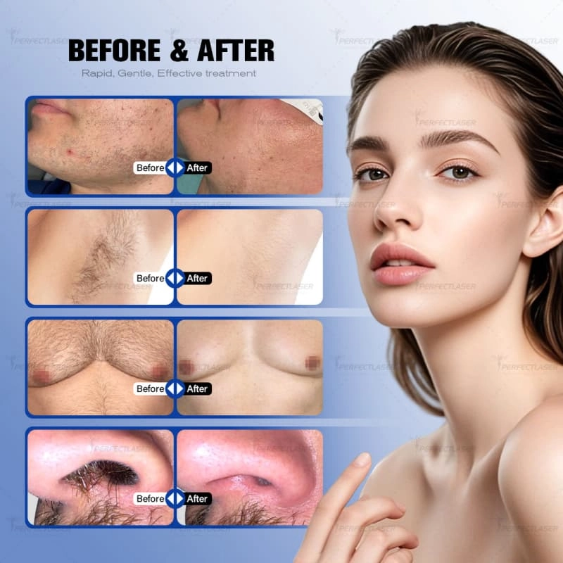 diode laser hair removal machine