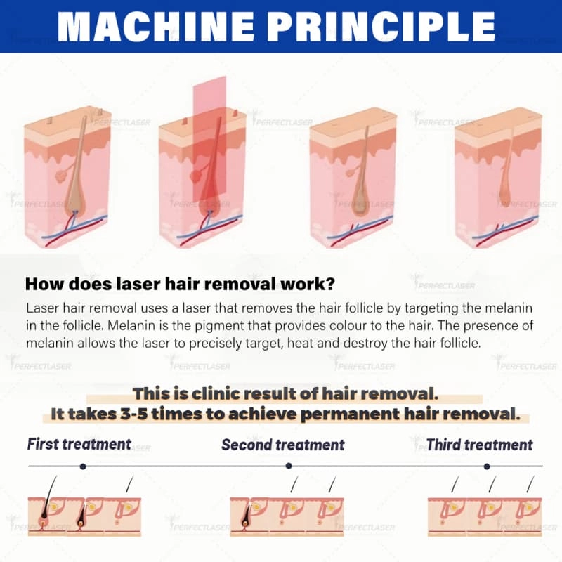 diode laser hair removal machine