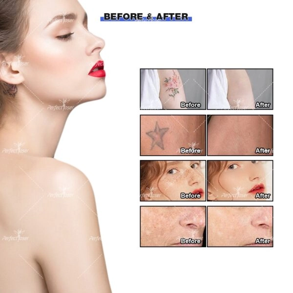 picosecond laser tattoo removal(4)