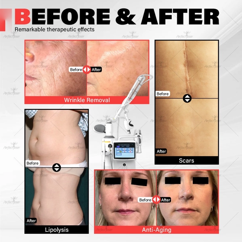 CO2 fractional laser.webp