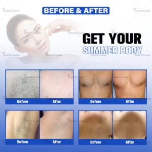 laser hair removal machine