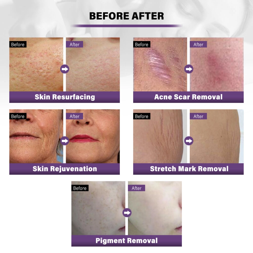 before and after CO2 laser
