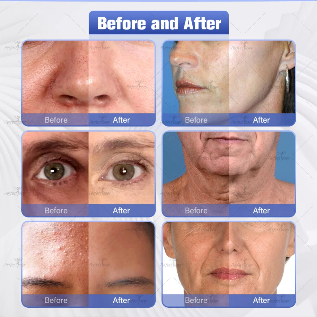 hydra skin peel machine